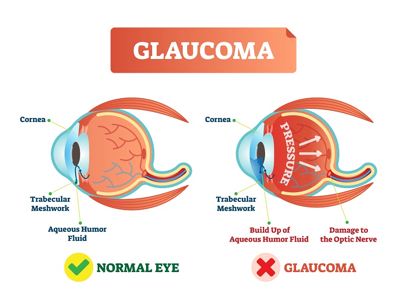 Glaucoma Testing, Diagnosis and Treatment