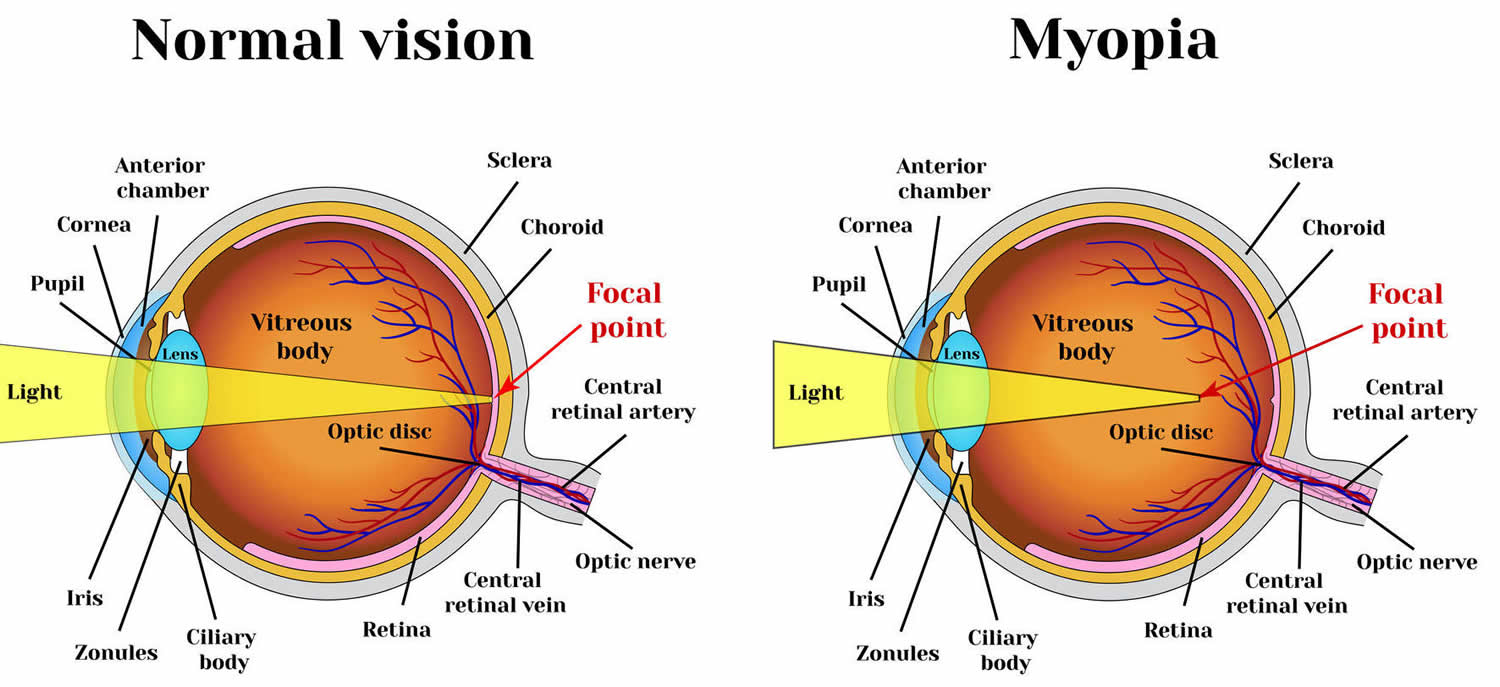 Myopia Eye Condition